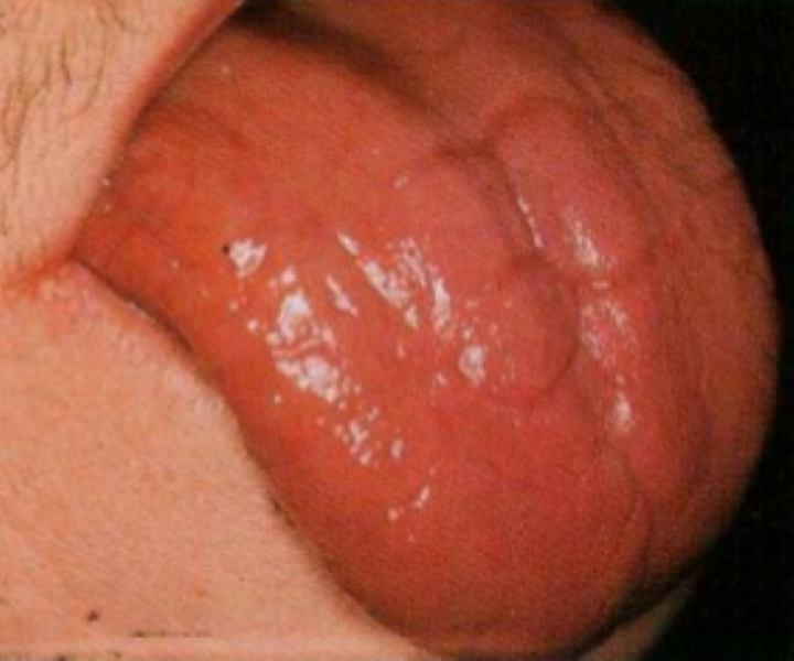 Tongues 