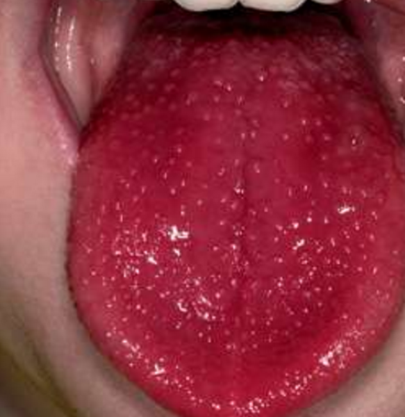 Tongues 